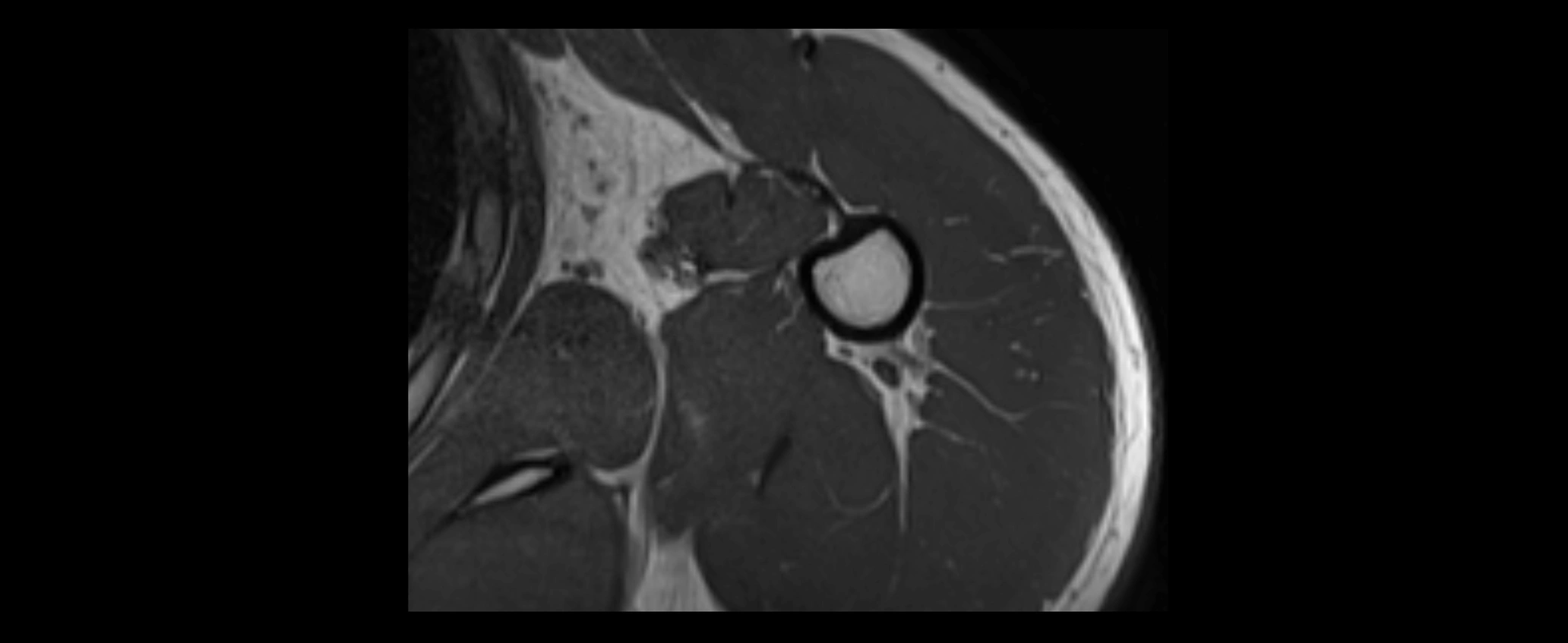 shoulder ligaments axial 3d 3t mri image-img-00005-00112.webp